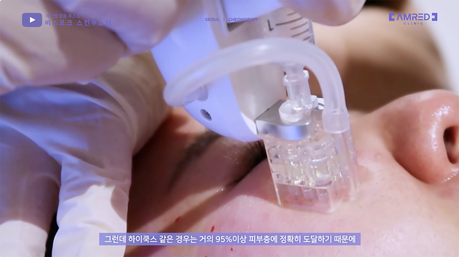 의료 전문가와 환자가 스킨부스터 시술 방식과 진피층 주입 깊이를 설명하는 의료 교육 장면