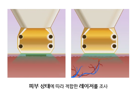 레이저가 피부 진피층의 색소를 선택적으로 파괴하는 원리 다이어그램