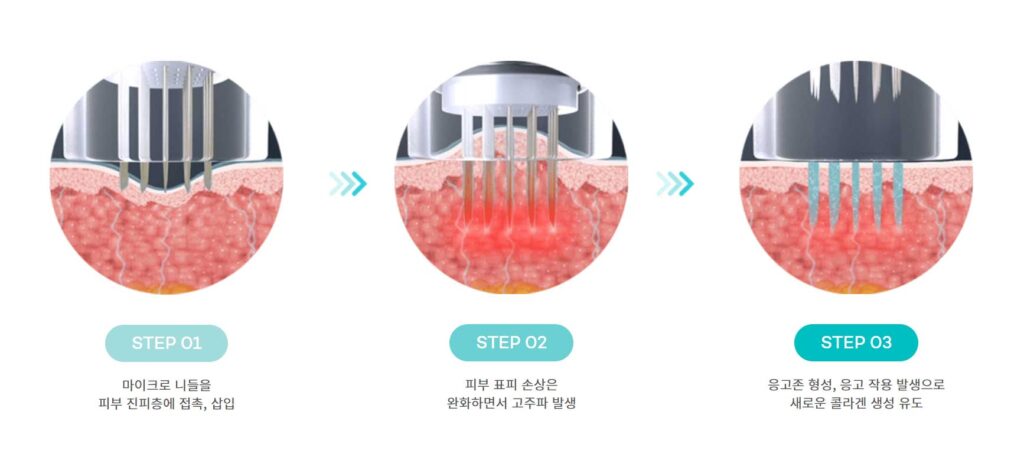 포텐자 마이크로니들이 피부 표면을 통과해 고주파 에너지를 진피층에 전달하는 과정을 단계별로 보여주는 다이어그램